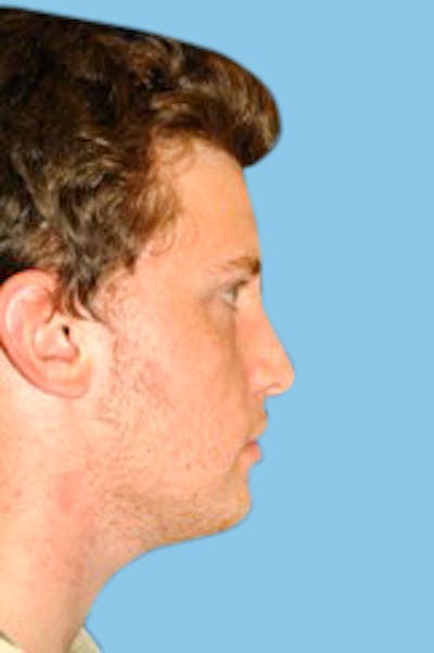 Rhinoplasty Before & After Gallery - Patient 173267 - Image 2