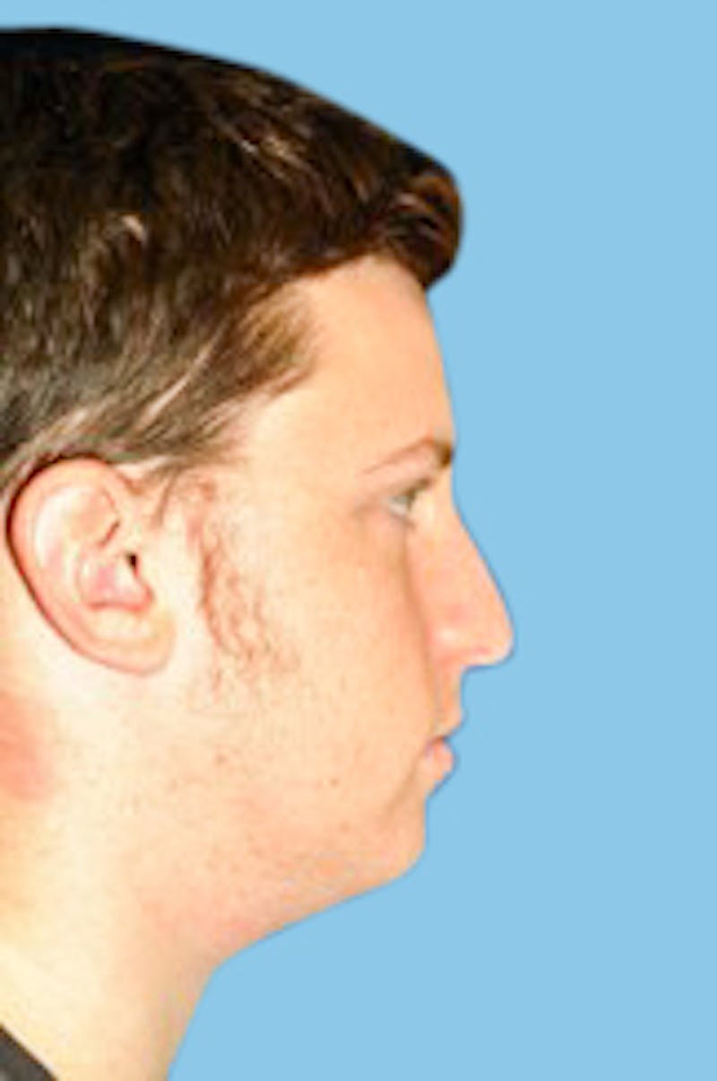 Rhinoplasty Before & After Gallery - Patient 173267 - Image 3