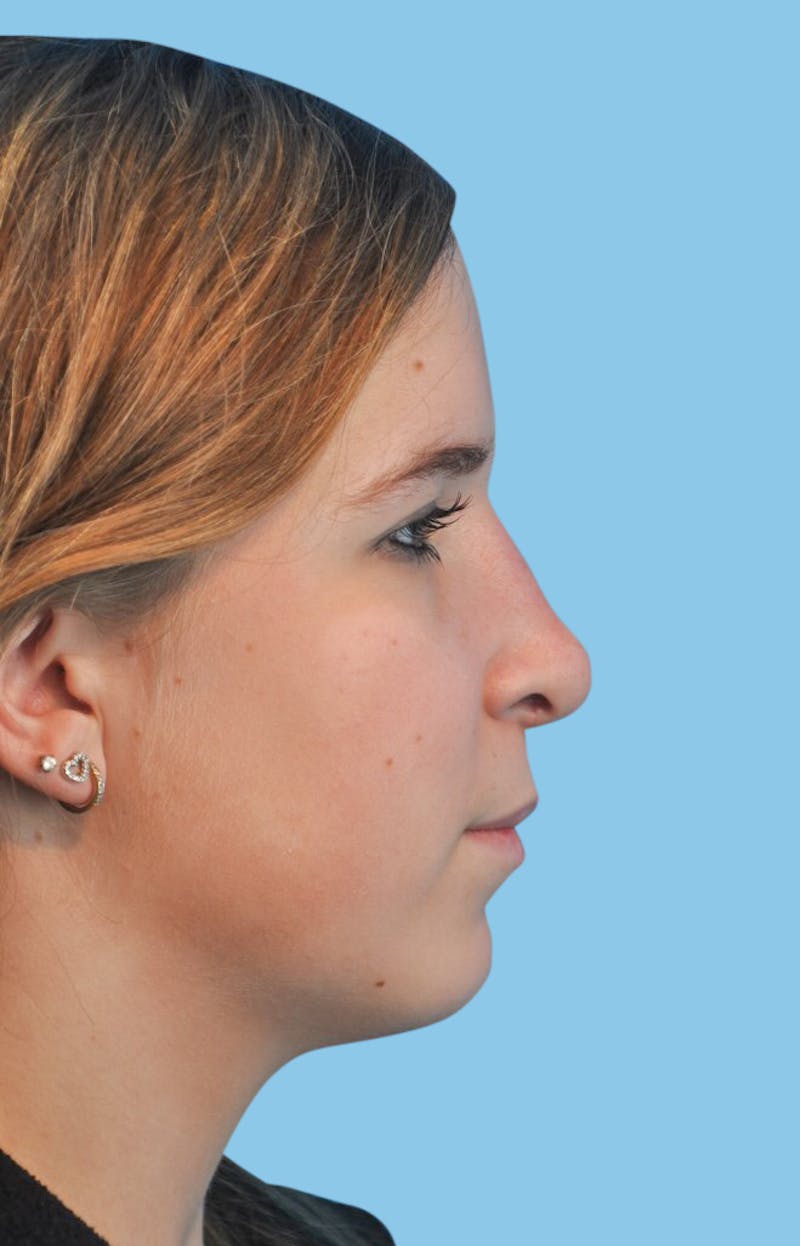 Rhinoplasty Before & After Gallery - Patient 614187 - Image 4