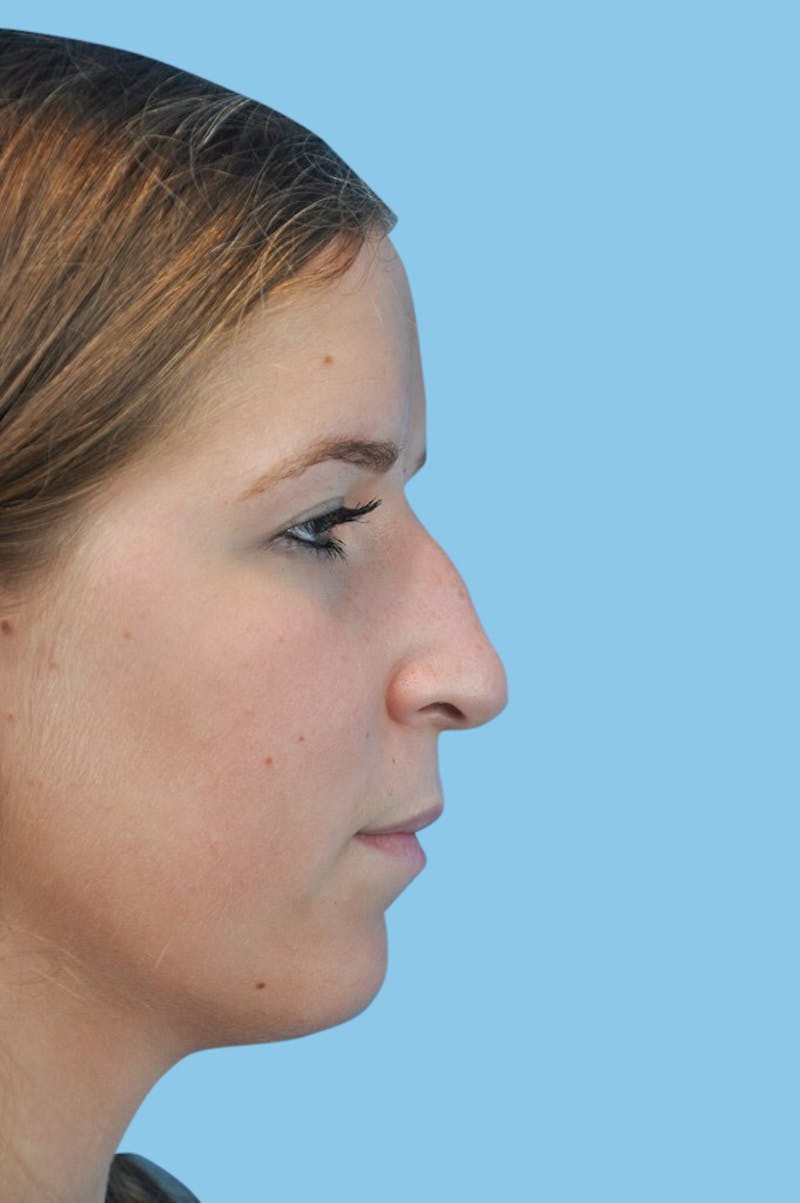 Rhinoplasty Before & After Gallery - Patient 614187 - Image 3