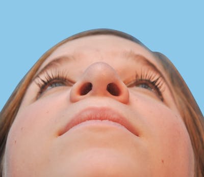 Rhinoplasty Before & After Gallery - Patient 373077 - Image 2