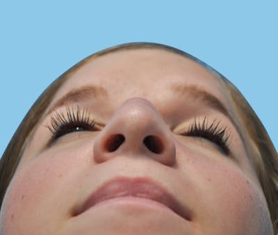 Rhinoplasty Before & After Gallery - Patient 373077 - Image 1