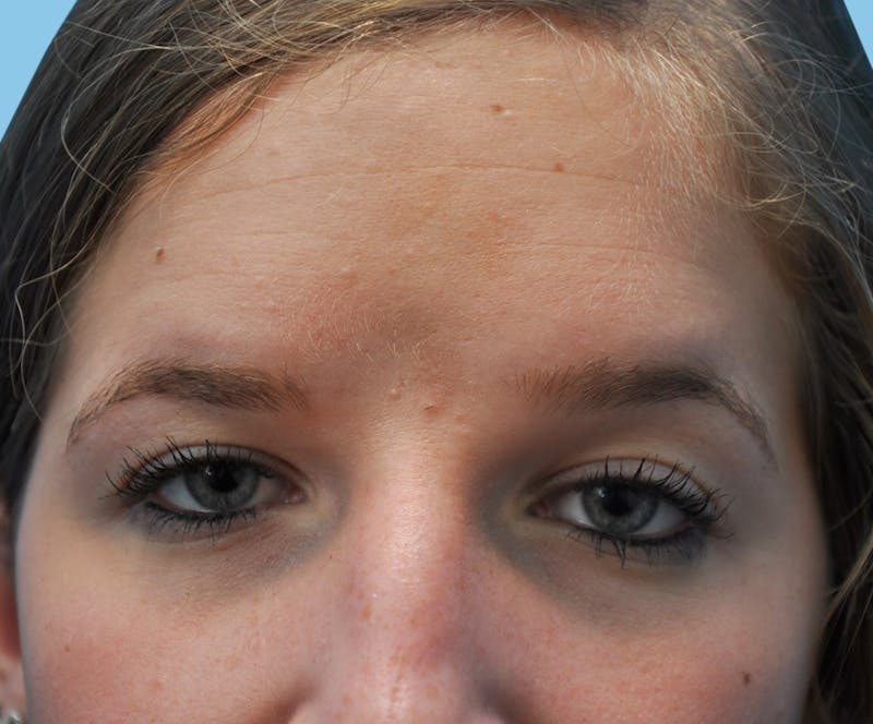 Rhinoplasty Before & After Gallery - Patient 373077 - Image 3