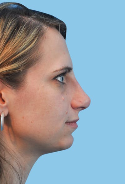 Rhinoplasty Before & After Gallery - Patient 339429 - Image 2