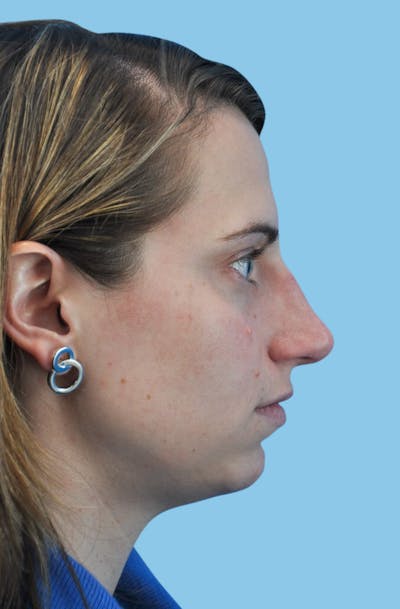 Rhinoplasty Before & After Gallery - Patient 339429 - Image 1