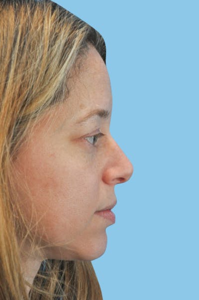 Rhinoplasty Before & After Gallery - Patient 210614 - Image 1