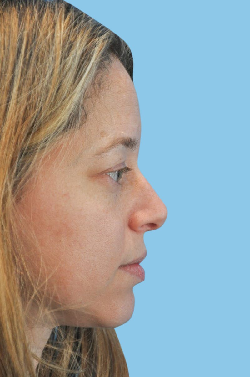 Rhinoplasty Before & After Gallery - Patient 210614 - Image 3
