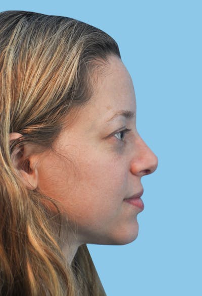 Rhinoplasty Before & After Gallery - Patient 210614 - Image 2