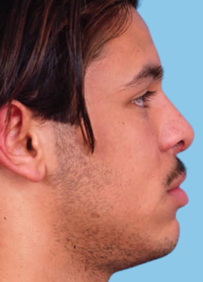 Rhinoplasty Before & After Gallery - Patient 340195 - Image 2