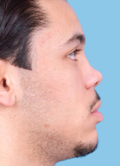 Rhinoplasty Before & After Gallery - Patient 340195 - Image 1