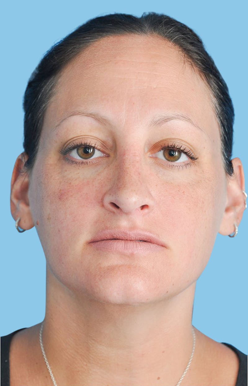 Rhinoplasty Before & After Gallery - Patient 309932 - Image 1