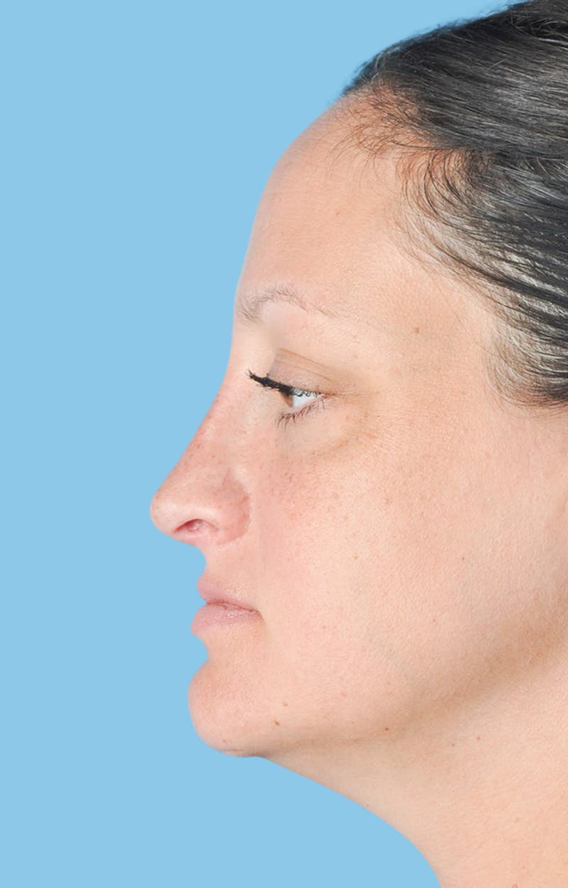 Rhinoplasty Before & After Gallery - Patient 309932 - Image 2