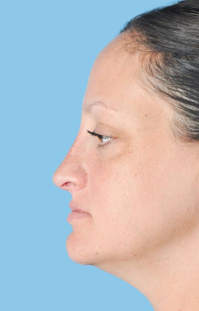 Rhinoplasty Before & After Gallery - Patient 309932 - Image 2