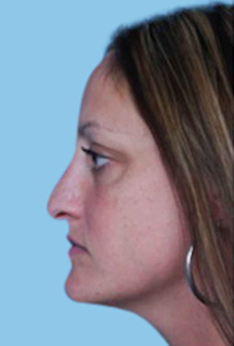 Rhinoplasty Before & After Gallery - Patient 309932 - Image 4