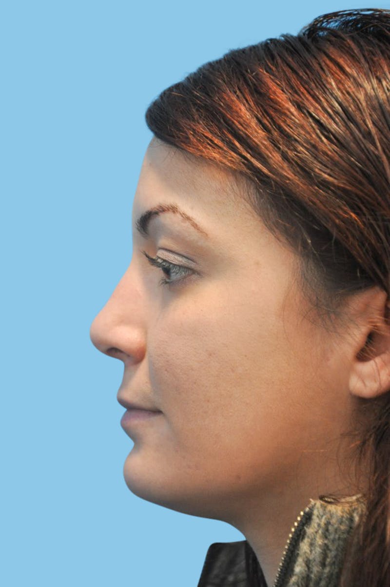 Rhinoplasty Before & After Gallery - Patient 143316 - Image 4