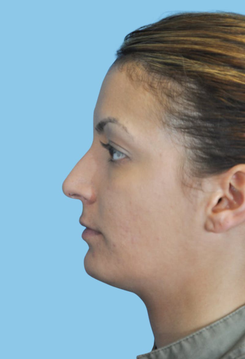 Rhinoplasty Before & After Gallery - Patient 143316 - Image 3