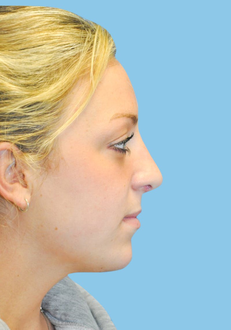 Rhinoplasty Before & After Gallery - Patient 172574 - Image 2