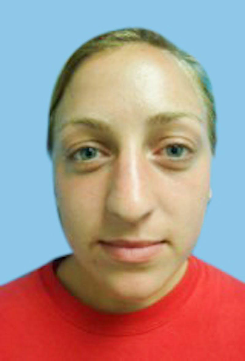 Rhinoplasty Before & After Gallery - Patient 172574 - Image 3