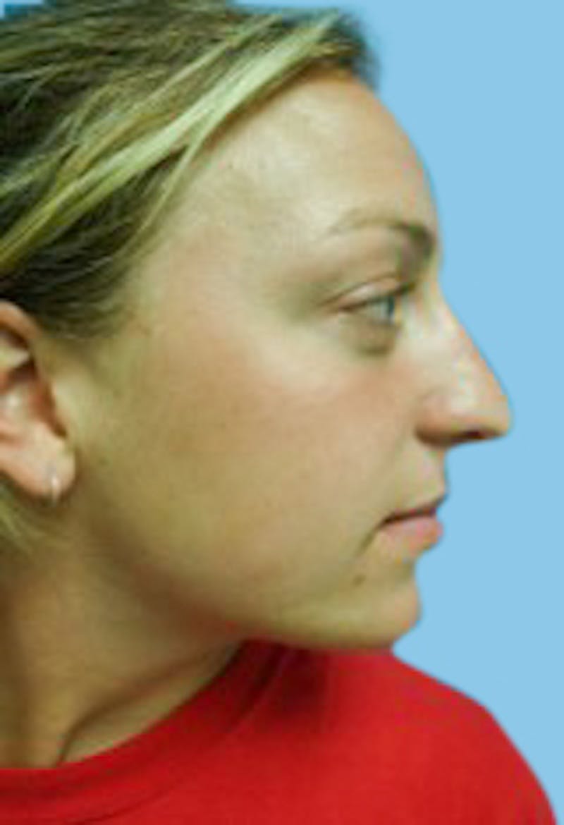 Rhinoplasty Before & After Gallery - Patient 172574 - Image 4