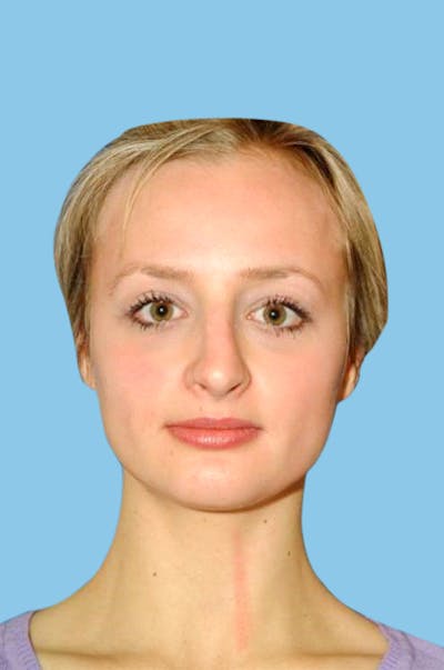 Rhinoplasty Before & After Gallery - Patient 270060 - Image 1