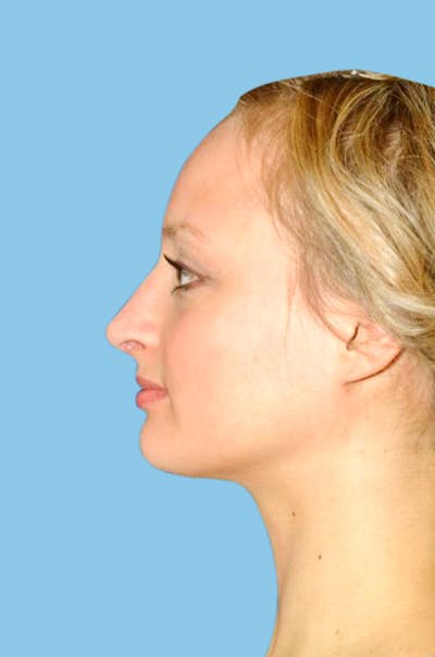 Rhinoplasty Before & After Gallery - Patient 270060 - Image 2