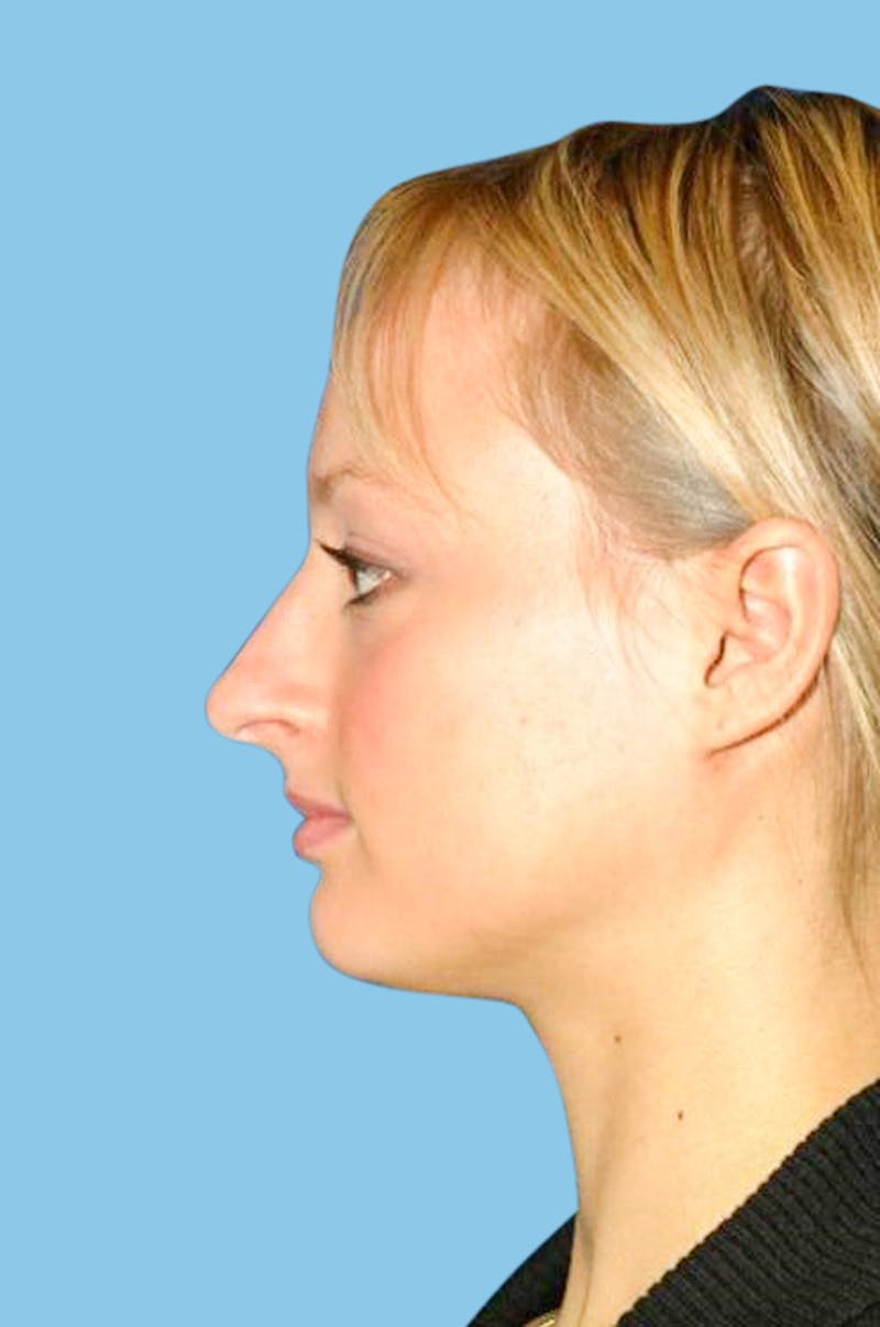 Rhinoplasty Before & After Gallery - Patient 270060 - Image 4