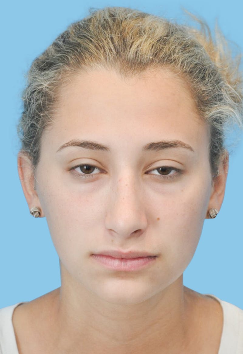 Rhinoplasty Before & After Gallery - Patient 309070 - Image 2