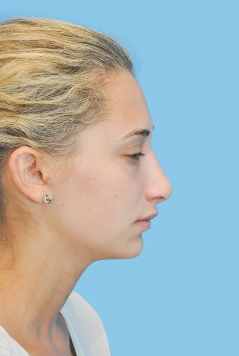 Rhinoplasty Before & After Gallery - Patient 309070 - Image 4