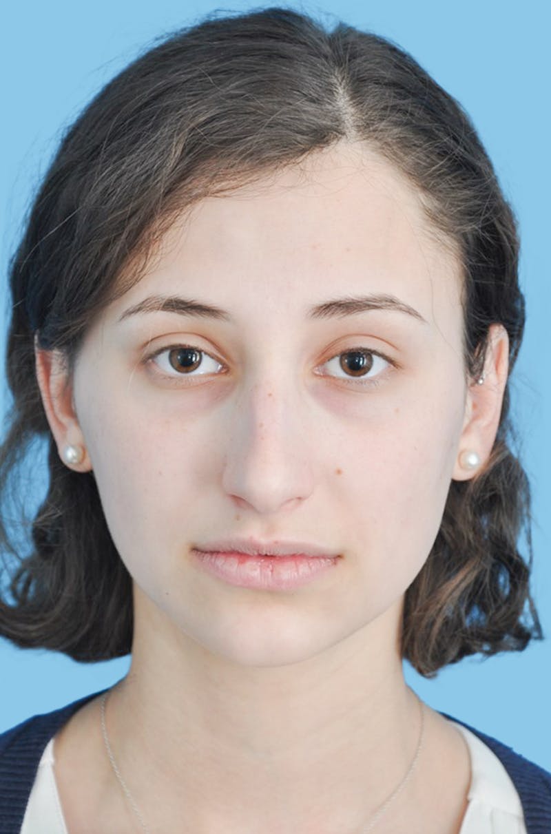 Rhinoplasty Before & After Gallery - Patient 309070 - Image 1