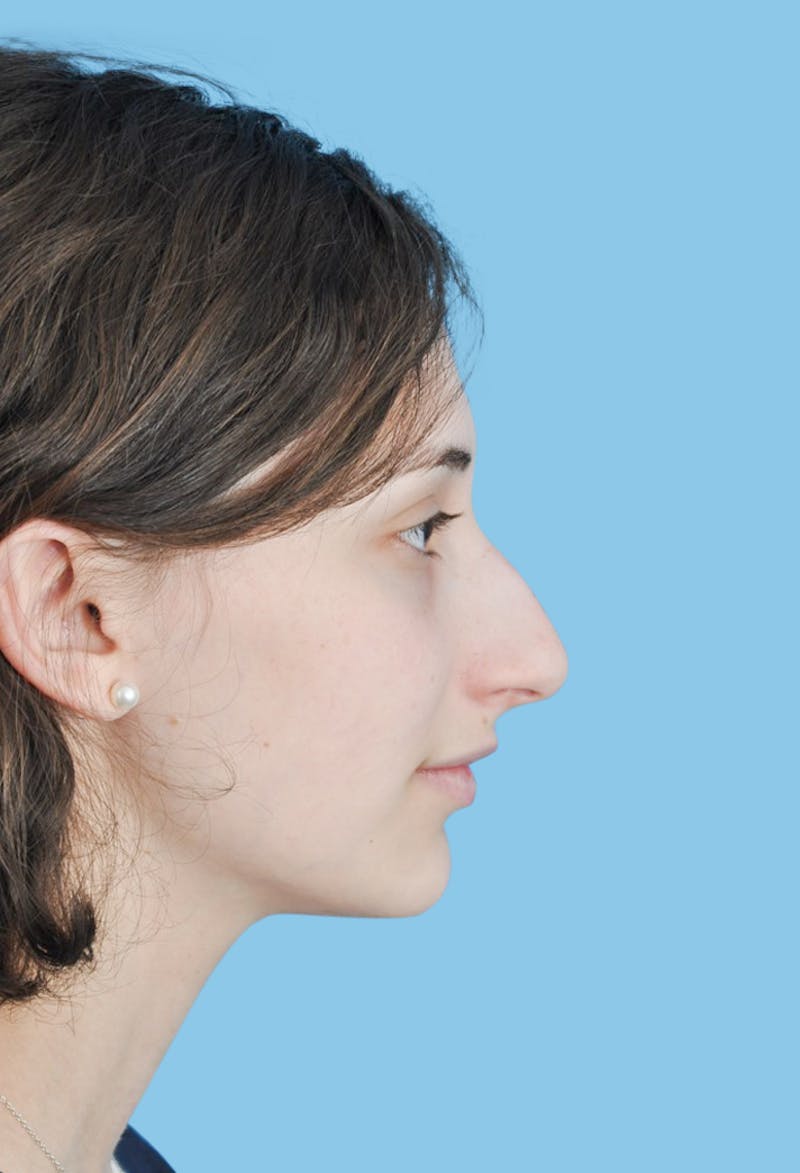 Rhinoplasty Before & After Gallery - Patient 309070 - Image 3