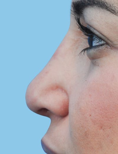 Rhinoplasty Before & After Gallery - Patient 191030 - Image 2