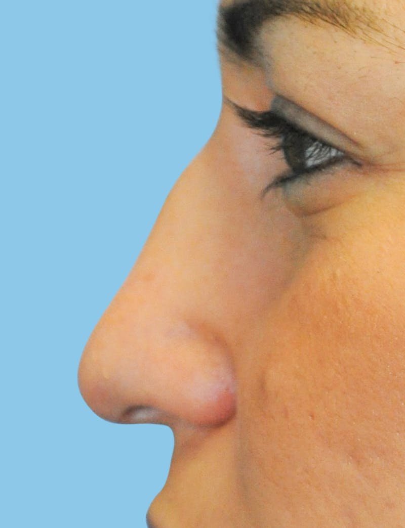 Rhinoplasty Before & After Gallery - Patient 191030 - Image 1