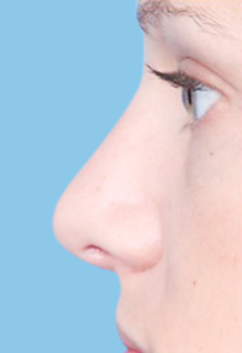 Rhinoplasty Before & After Gallery - Patient 315021 - Image 2