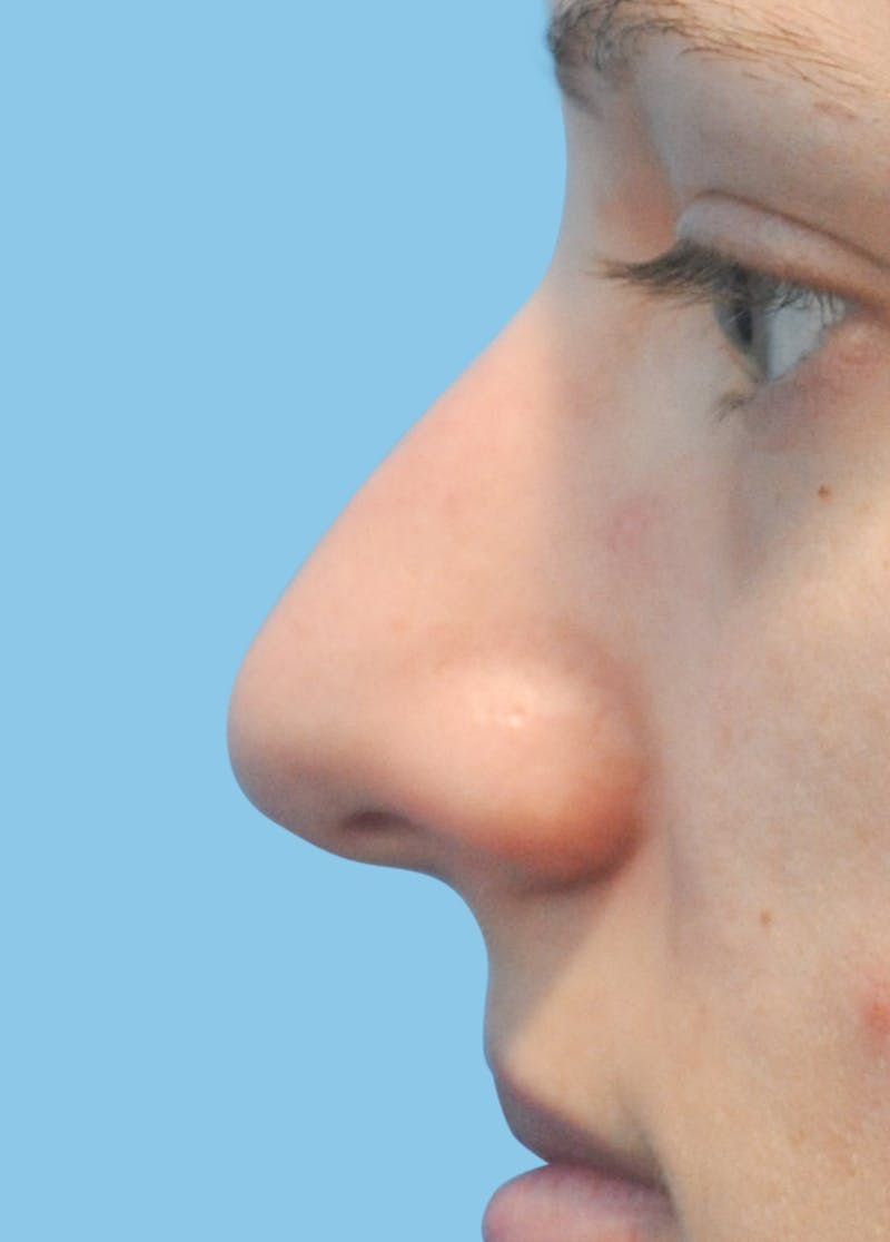 Rhinoplasty Before & After Gallery - Patient 315021 - Image 1