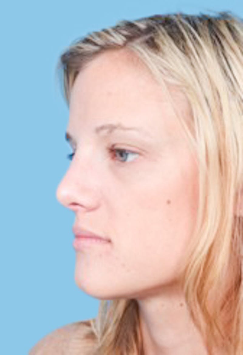 Rhinoplasty Before & After Gallery - Patient 342340 - Image 4