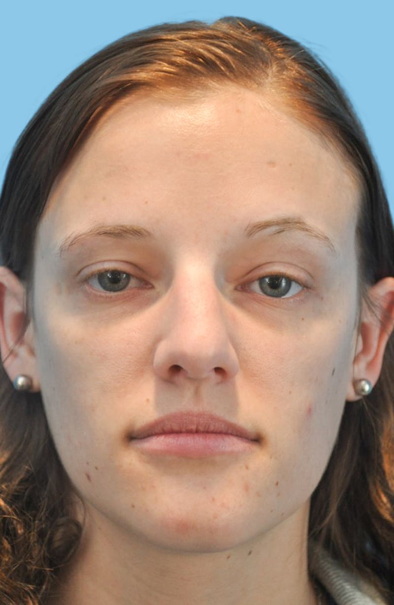 Rhinoplasty Before & After Gallery - Patient 342340 - Image 1