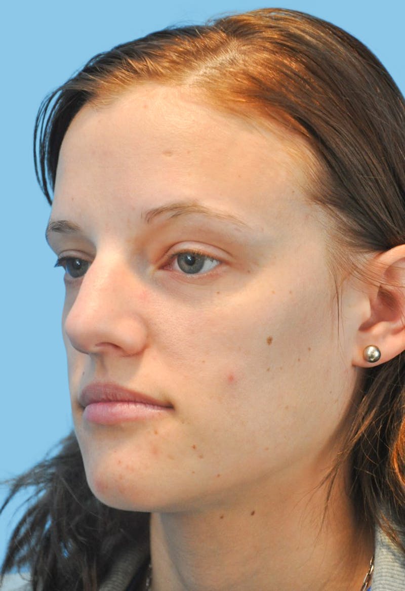 Rhinoplasty Before & After Gallery - Patient 342340 - Image 3