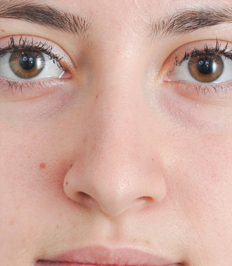 Rhinoplasty Before & After Gallery - Patient 263776 - Image 2