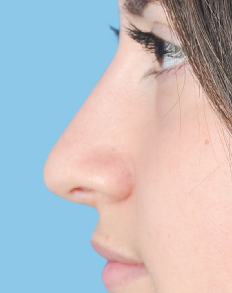 Rhinoplasty Before & After Gallery - Patient 263776 - Image 4