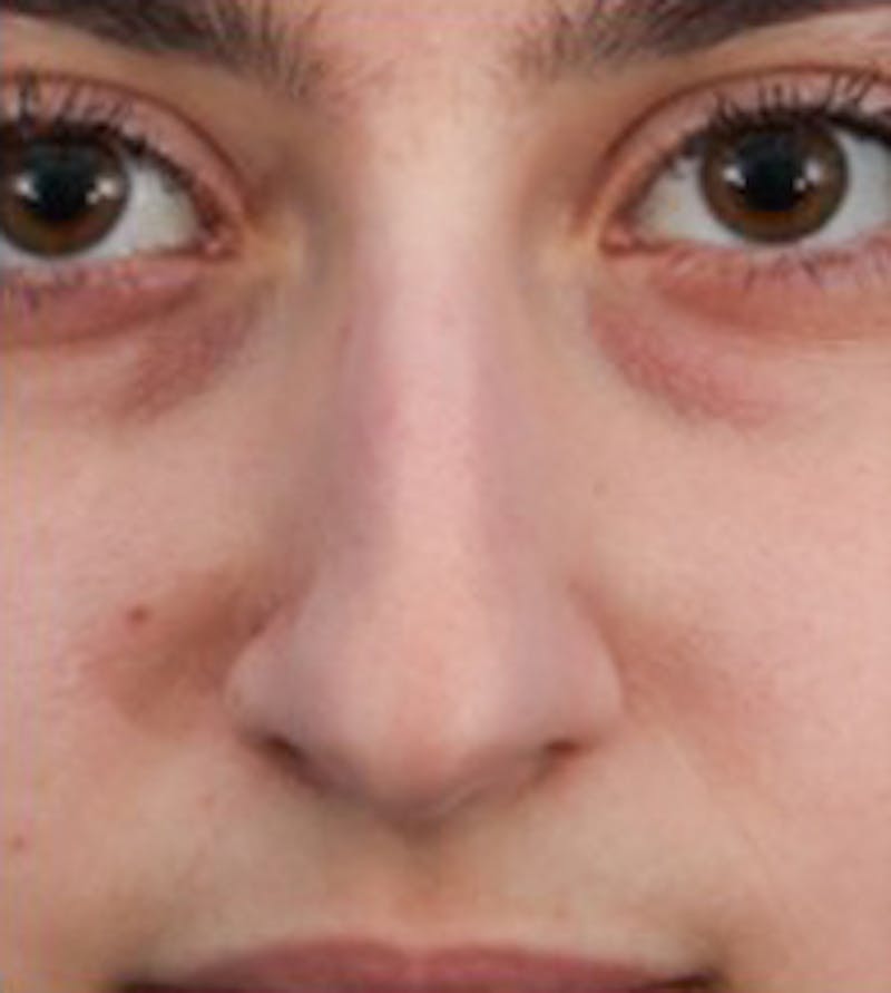 Rhinoplasty Before & After Gallery - Patient 263776 - Image 1