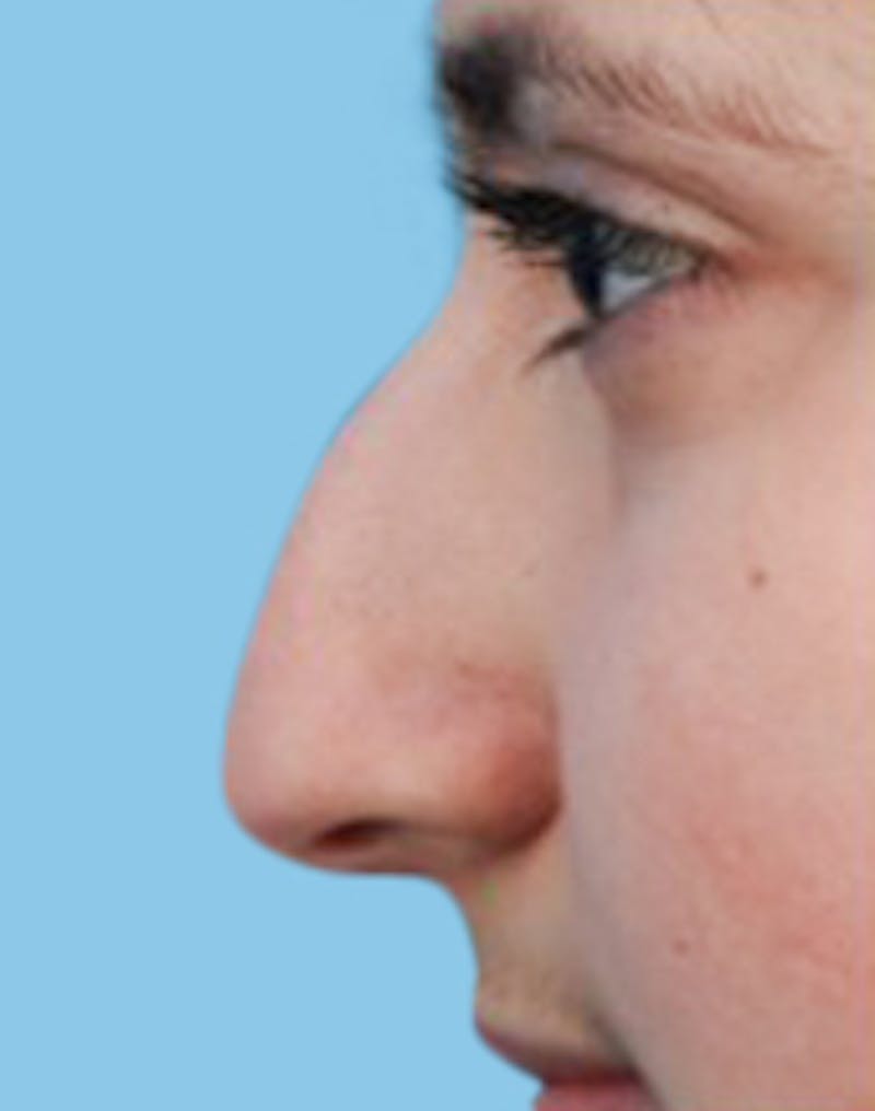 Rhinoplasty Before & After Gallery - Patient 263776 - Image 3