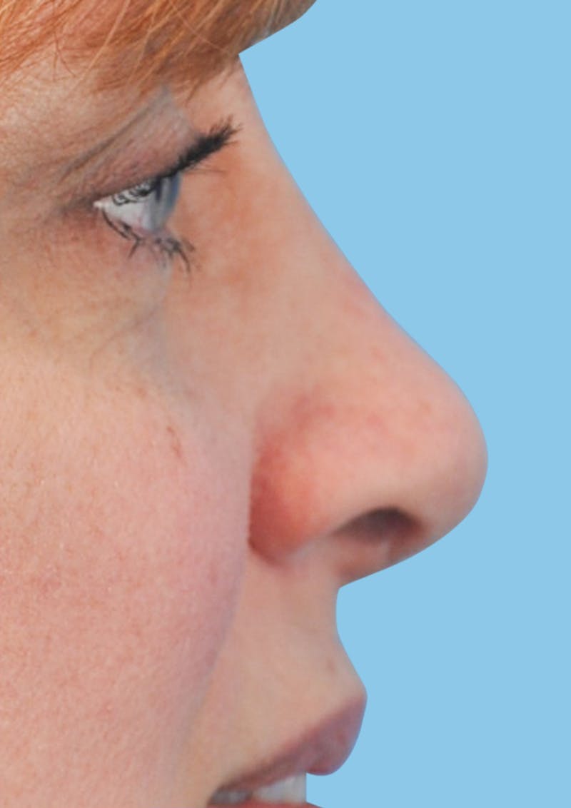 Rhinoplasty Before & After Gallery - Patient 334753 - Image 2
