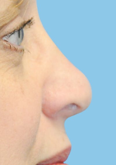 Rhinoplasty Before & After Gallery - Patient 334753 - Image 1