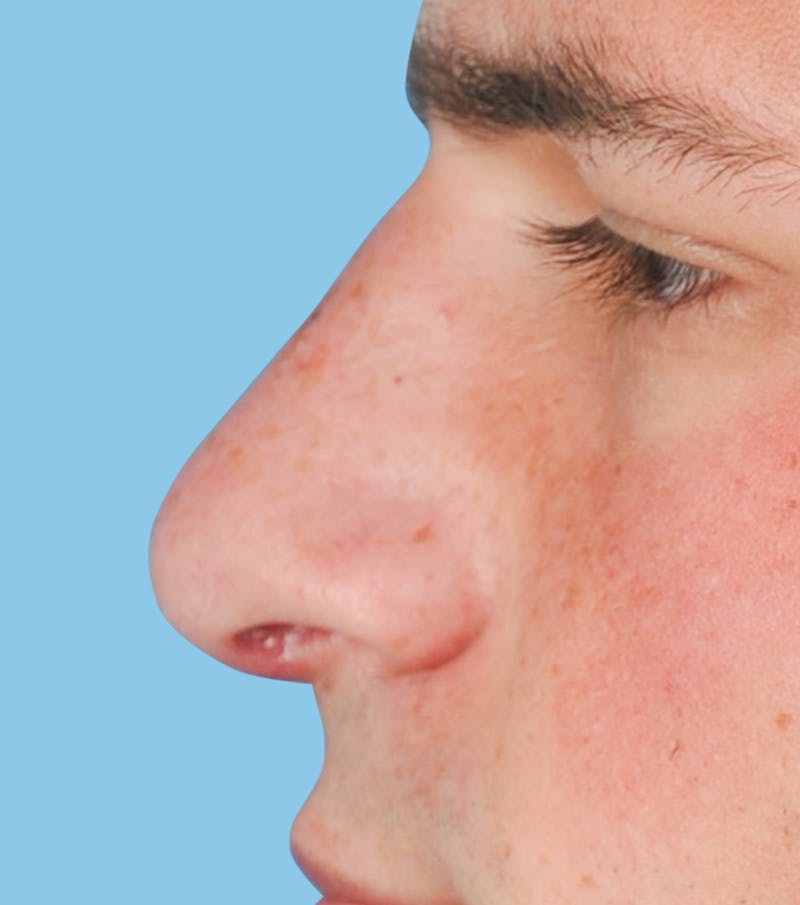 Rhinoplasty Before & After Gallery - Patient 182642 - Image 2