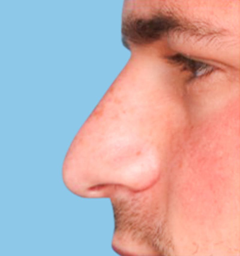 Rhinoplasty Before & After Gallery - Patient 182642 - Image 1