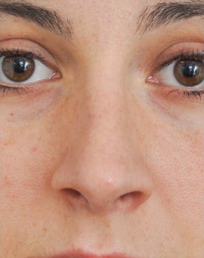 Rhinoplasty Before & After Gallery - Patient 143342 - Image 2