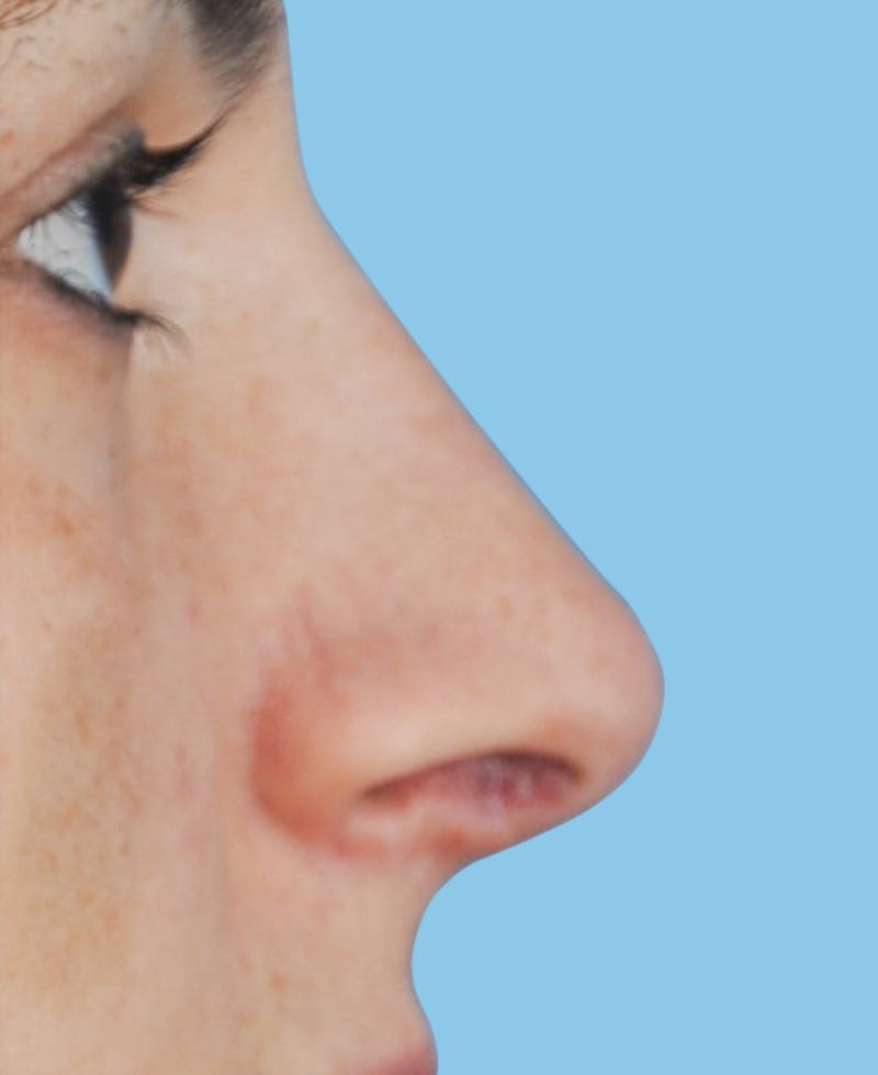 Rhinoplasty Before & After Gallery - Patient 143342 - Image 4