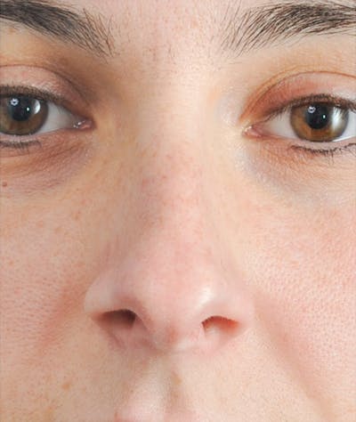 Rhinoplasty Before & After Gallery - Patient 143342 - Image 1