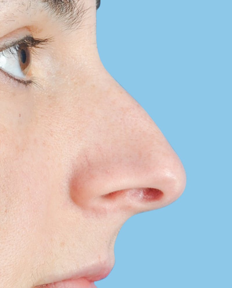 Rhinoplasty Before & After Gallery - Patient 143342 - Image 3