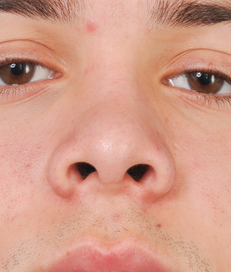 Rhinoplasty Before & After Gallery - Patient 597888 - Image 2